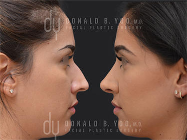 Before and After Photo of Rhinoplasty Procedure