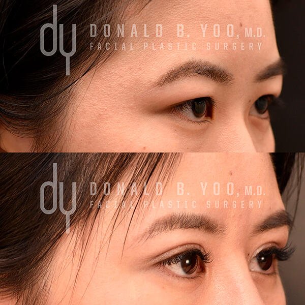 Side view of before and after photo of Asian Eyelid Surgery results