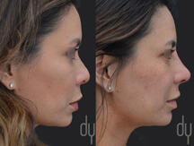 Before and after surgical Asian rhinoplasty