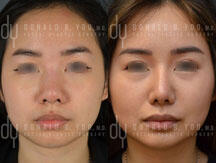 Before and After primary Asian rhinoplasty