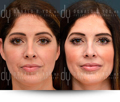 Photo of Botox/Dysport patient