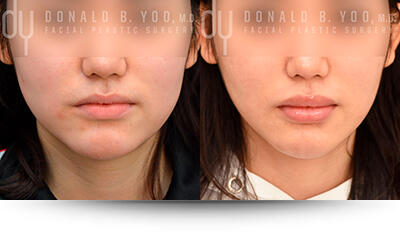 Buccal Fat Pad Removal - Learning Plastic Surgery