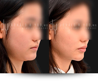 The Procedure of Buccal Pad Fat Removal