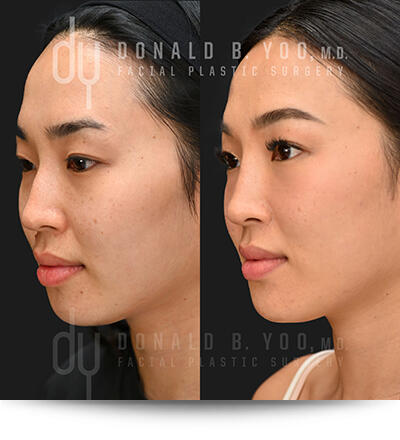 Before and After Nonsurgical Chin Augmentation