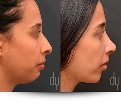 Non-Surgical Jawline Contouring - An Alternative to Facial Implants