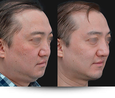 Chin Augmentation / Implant patient