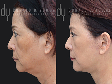 Facelift Before and After