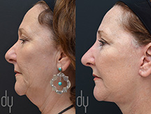 Facelift Before and After