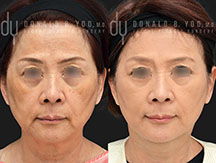 Facelift Before and After