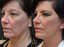 Facelift Before and After