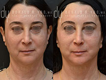 Facelift Before and After