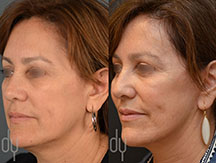 Facelift Before and After