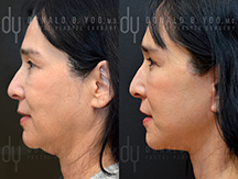 Facelift Before and After