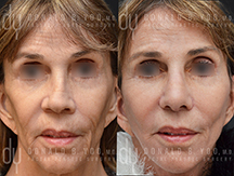 Facelift Before and After