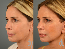 Facelift Before and After