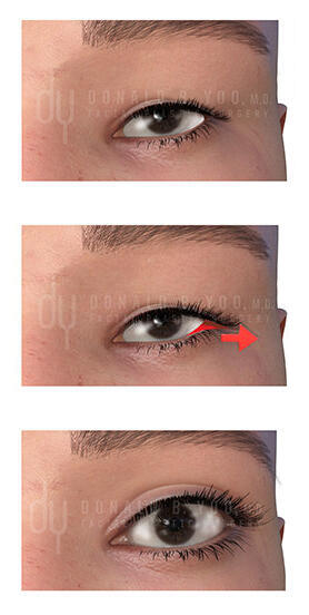 Lateral canthoplasty