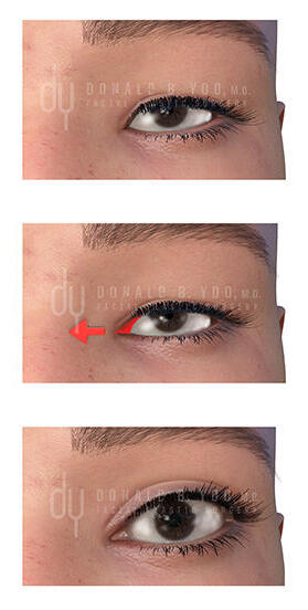 Medial canthoplasty