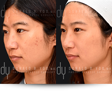 left view - before and after PicoSure Pro