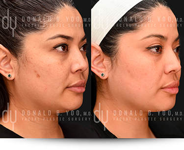 Before and After of PicoSure Pro treatment