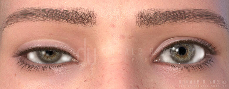 Ptosis