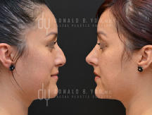 Surgical Rhinoplasty (before and after)