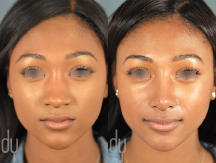 Surgical Rhinoplasty procedure