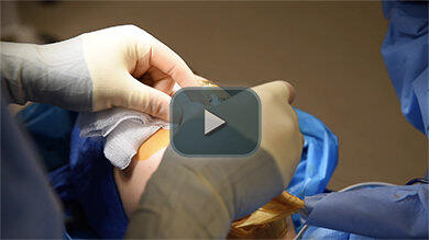Rhinoplasty Nose Incision Video